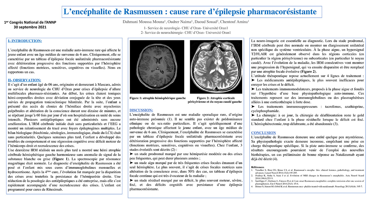 L’encéphalite de Rasmussen : cause rare d’épilepsie pharmacorésistante