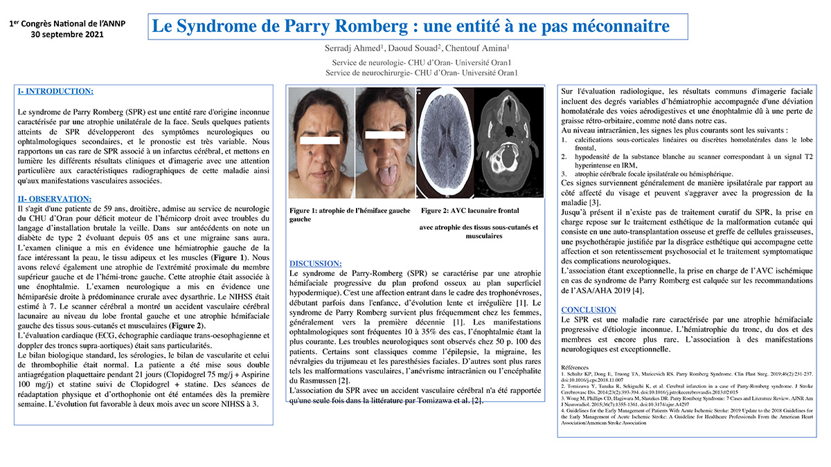 Le Syndrome de Parry Romberg : une entité à ne pas méconnaitre