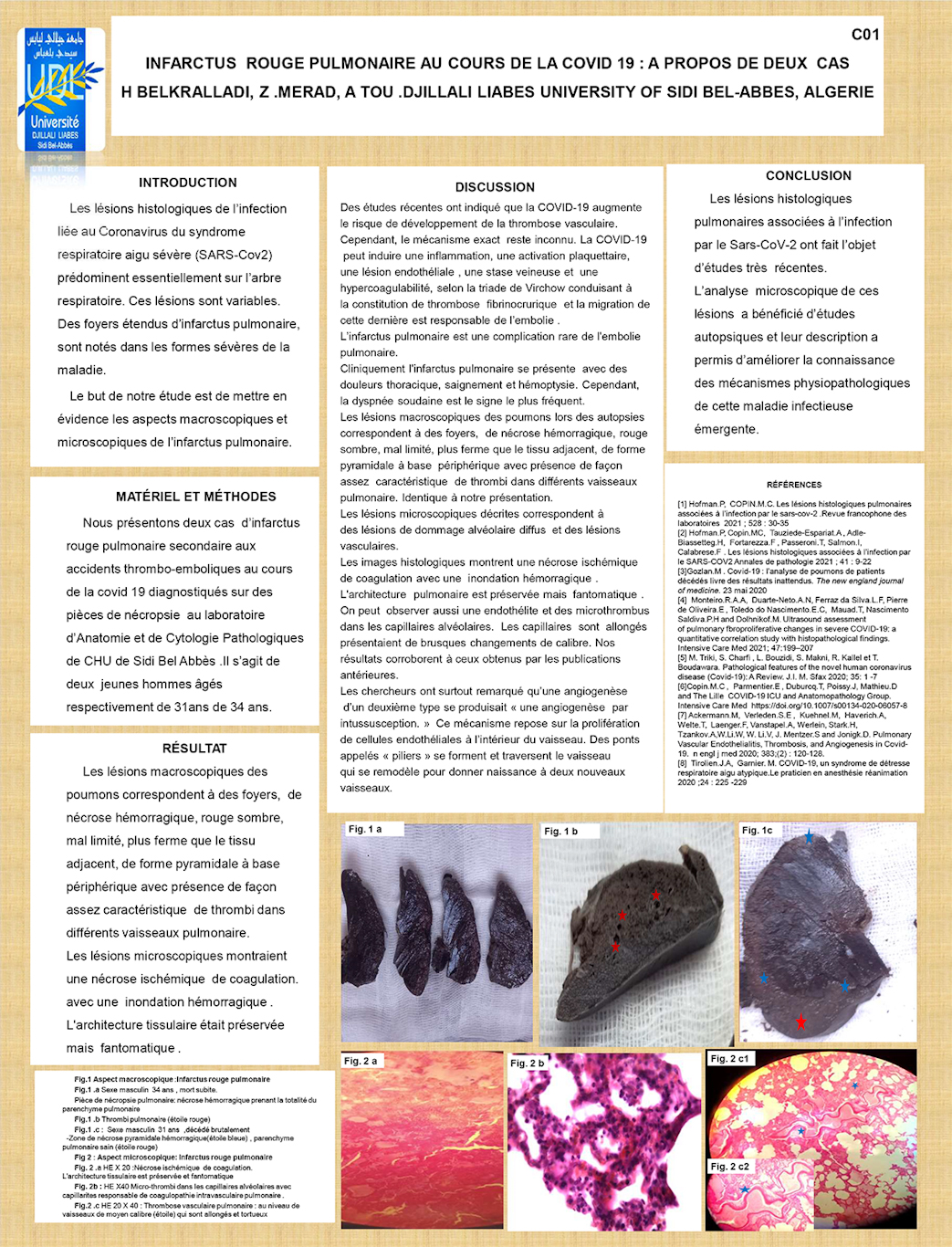 C01: INFARCTUS  ROUGE PULMONAIRE AU COURS DE LA COVID 19 : A PROPOS DE DEUX  CAS