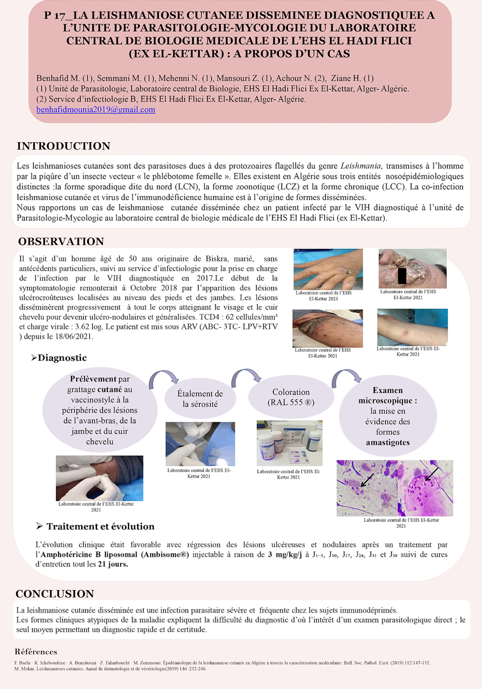 P17: LA LEISHMANIOSE CUTANEE DISSEMINEE DIAGNOSTIQUEE A L’UNITE DE PARASITOLOGIE-MYCOLOGIE DU LABORATOIRE CENTRAL DE BIOLOGIE MEDICALE DE L’EHS EL HADI FLICI (EX EL-KETTAR) : A PROPOS D’UN CAS