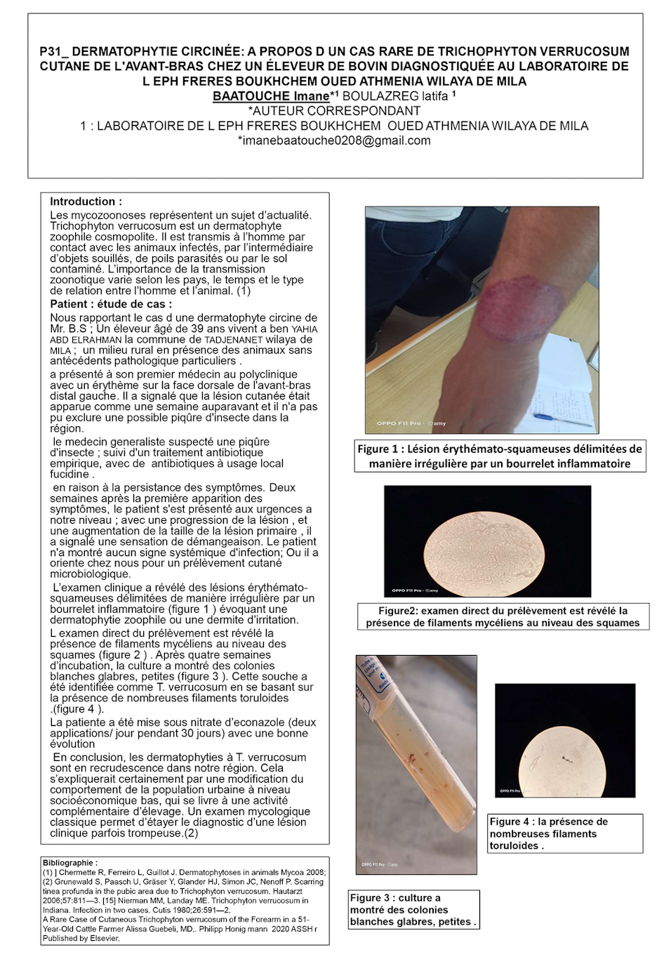 P31: DERMATOPHYTIE CIRCINÉE: A PROPOS D UN CAS RARE DE TRICHOPHYTON VERRUCOSUM CUTANE DE L'AVANT-BRAS CHEZ UN ÉLEVEUR DE BOVIN DIAGNOSTIQUÉE AU LABORATOIRE DE L EPH FRERES BOUKHCHEM OUED ATHMENIA WILAYA DE MILA