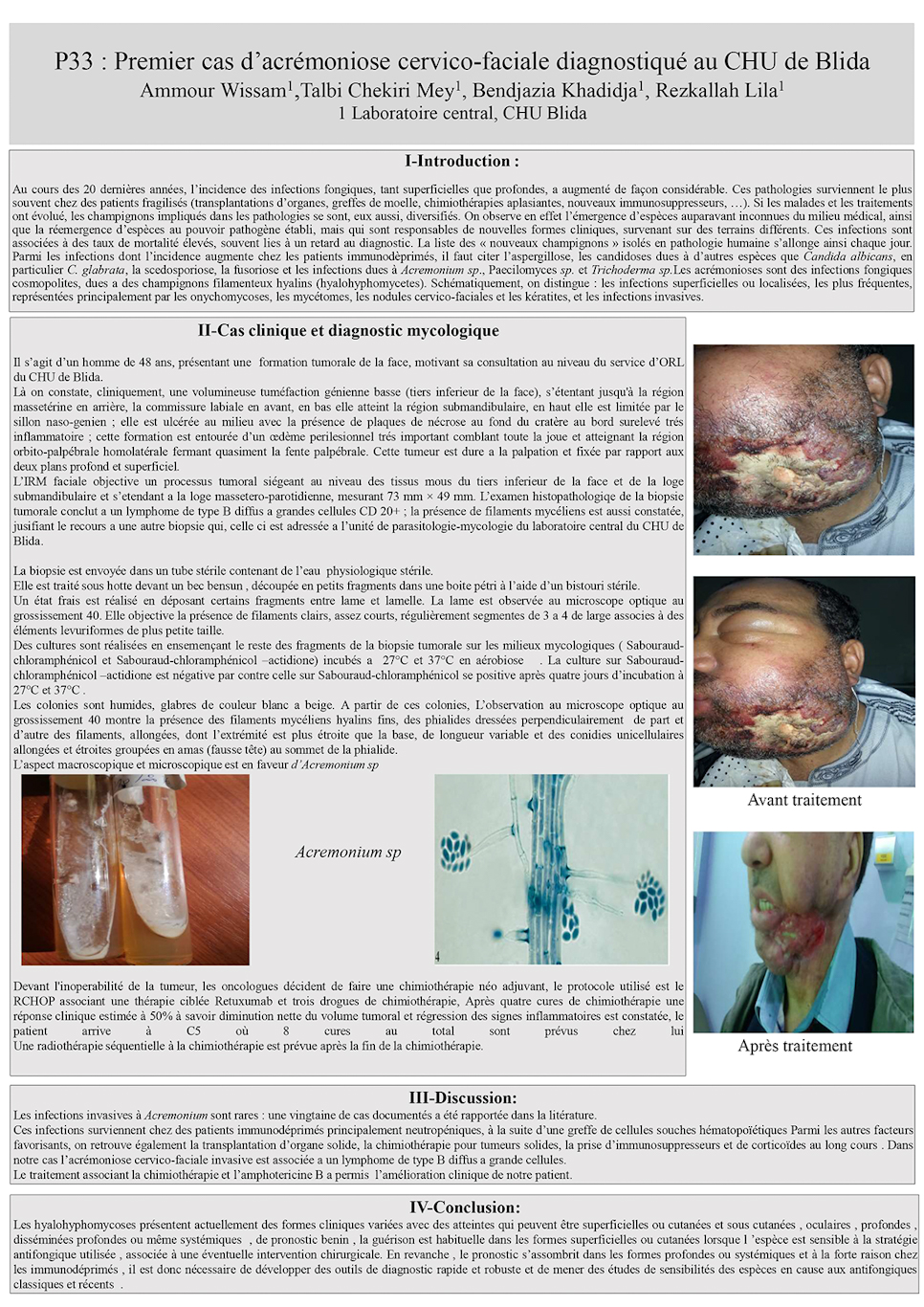 P33: Premier cas d’acrémoniose cervico-faciale diagnostiqué au CHU de Blida