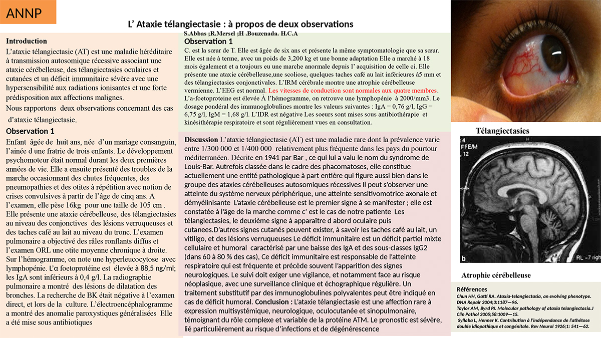 NV-12 L’Ataxie télangiectasie : à propos de deux observations.