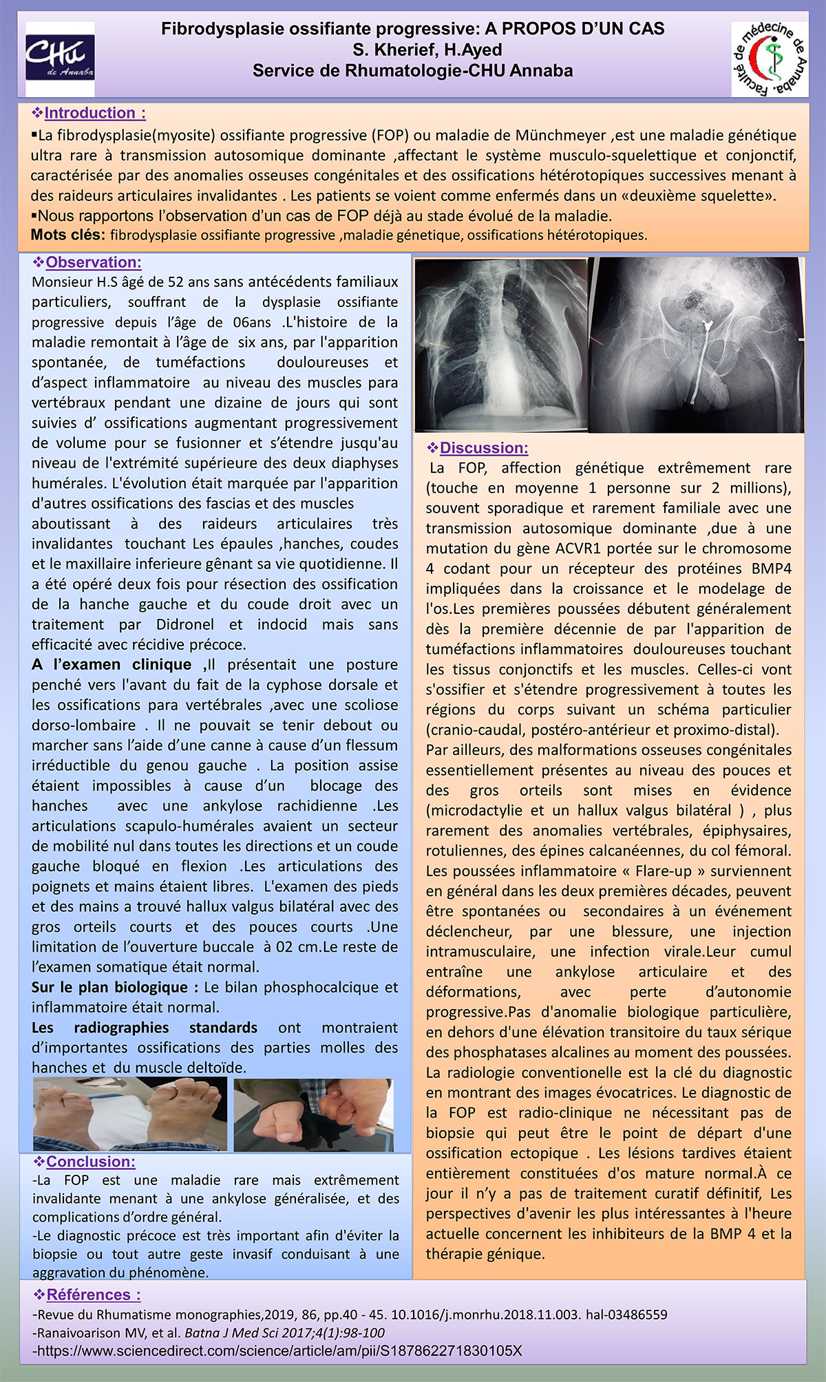 Fibrodysplasie ossifiante progressive: A PROPOS D’UN CAS