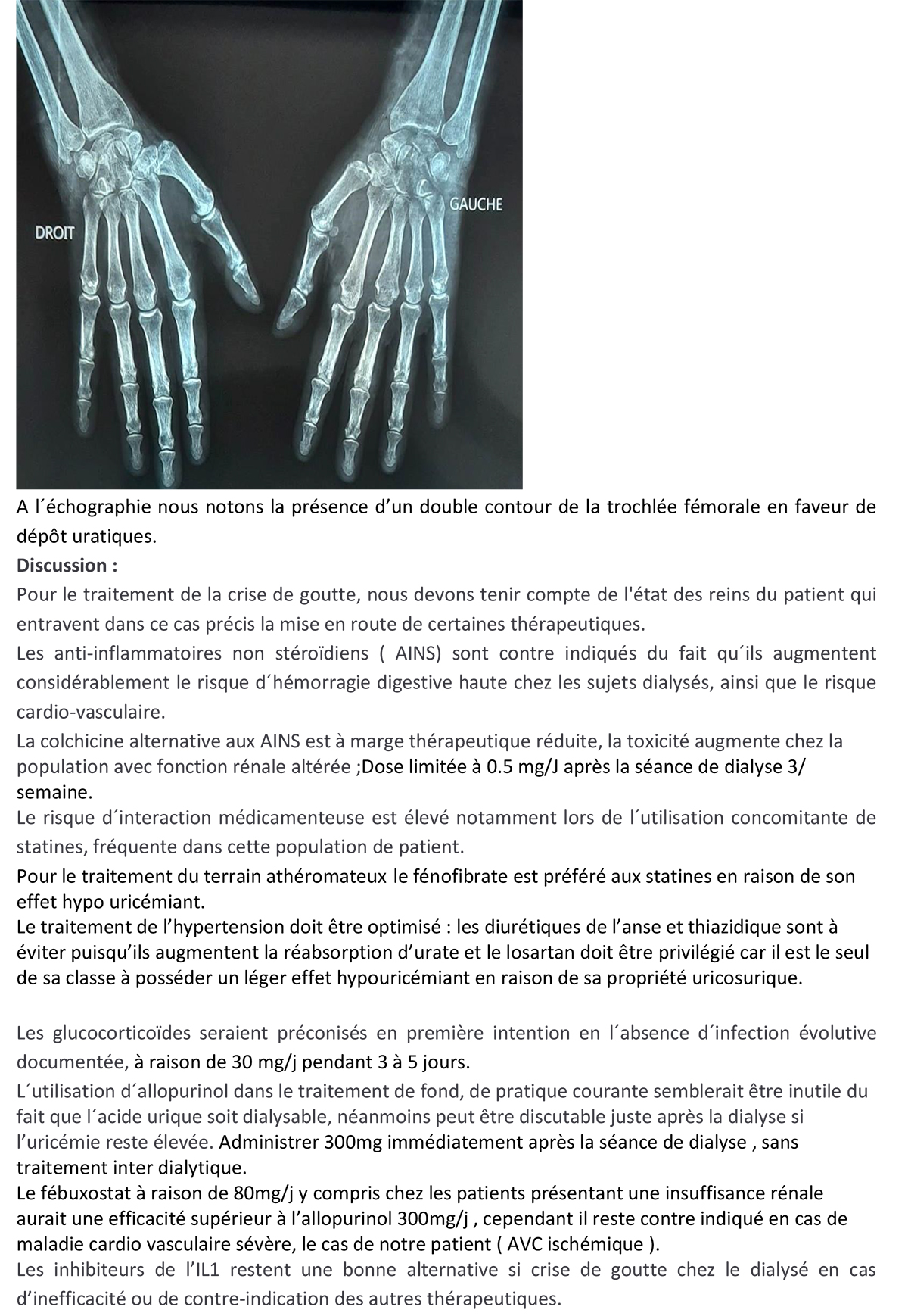 Goutte chronique polyarticulaire sévère finissant par une dialyse rénale