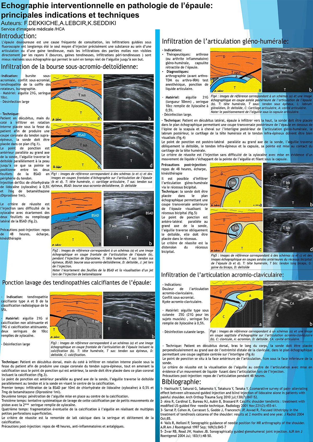 Echographie interventionnelle en pathologie de l’épaule: principales indications et techniques