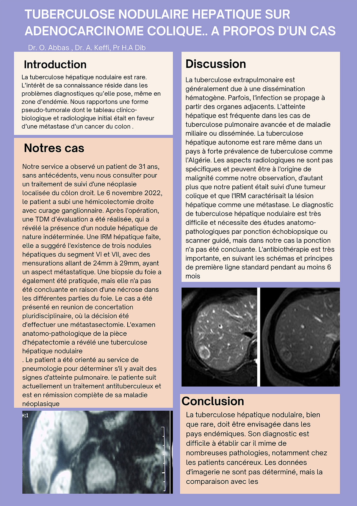 TUBERCULOSE NODULAIRE HEPATIQUE SURADENOCARCINOME COLIQUE.. A PROPOS D'UN CAS