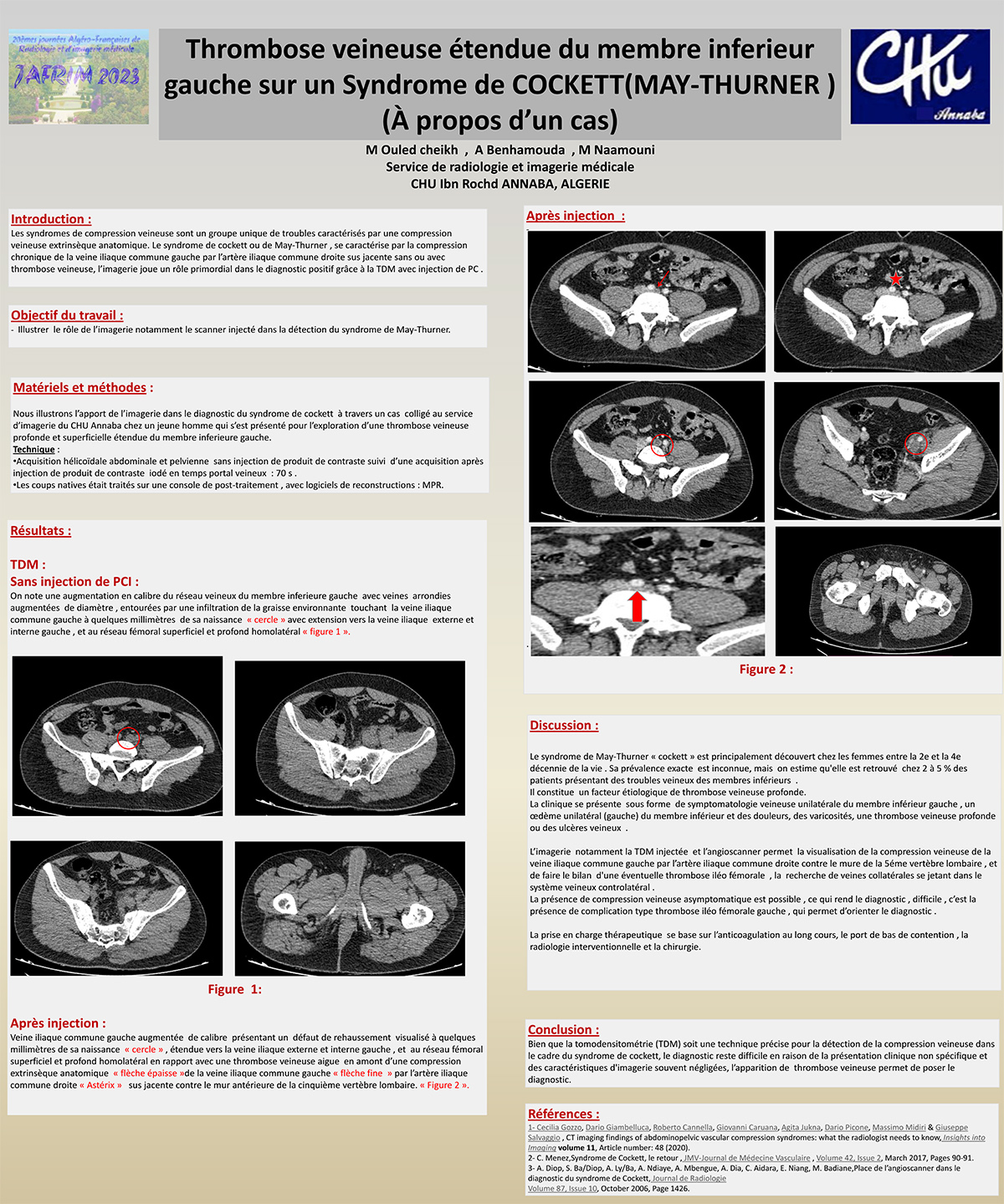 Thrombose veineuse étendue du membre inferieur gauche sur un Syndrome de COCKETT(MAY-THURNER ) (À propos d’un cas)