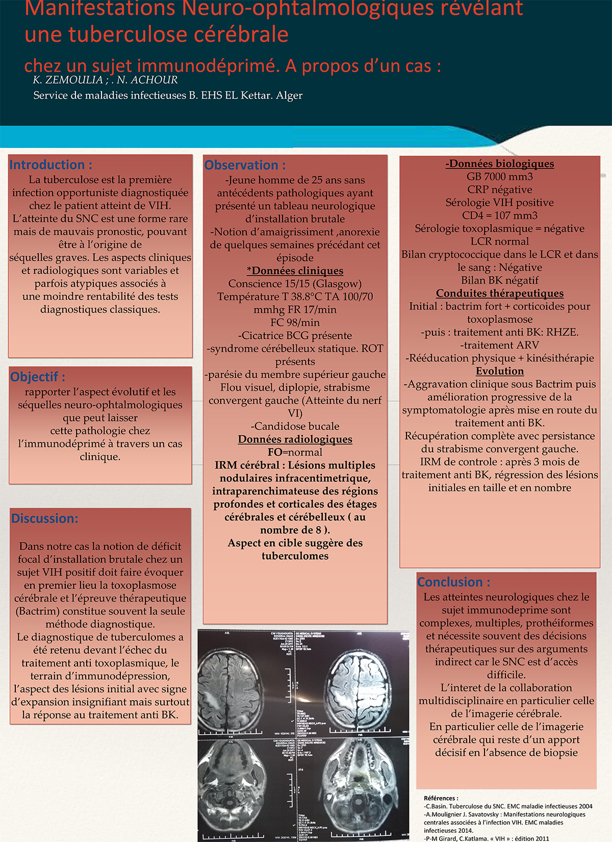 NO-7 Manifestations Neuro-ophtalmologiques révélant une tuberculose cérébrale chez un sujet immunodéprimé.