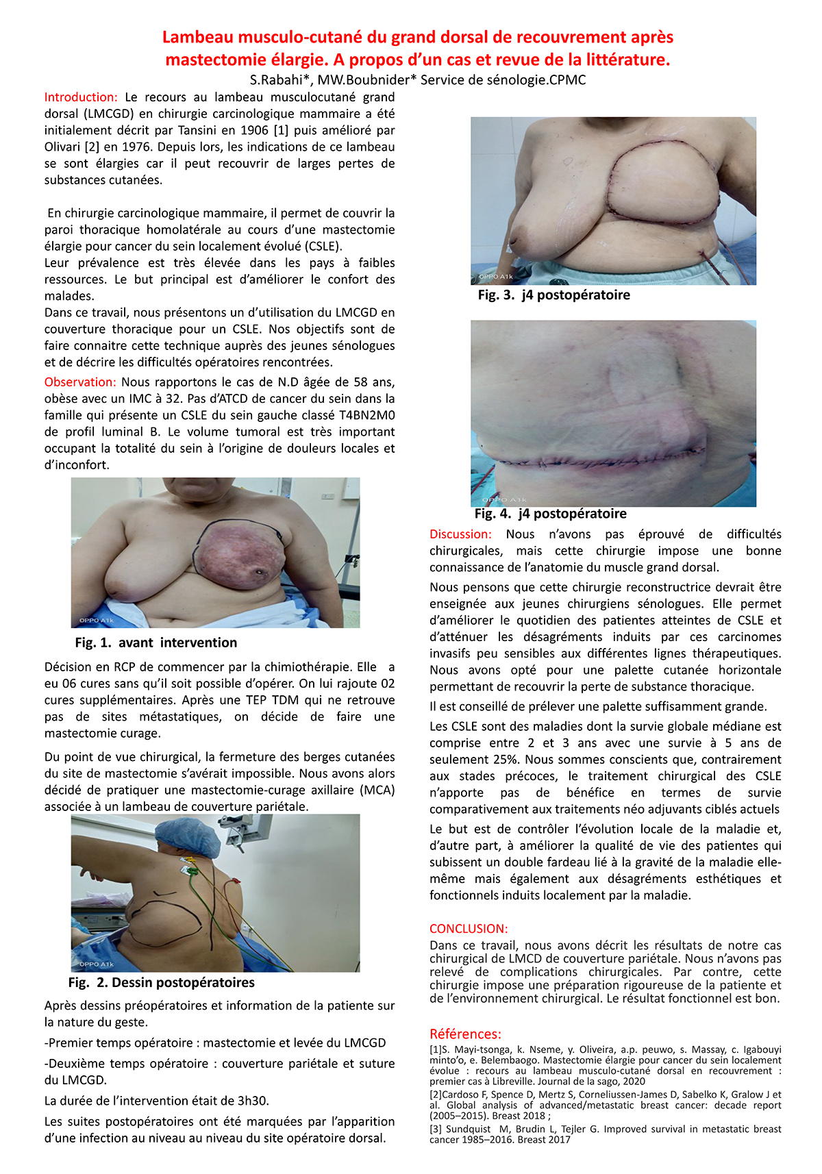 Lambeau musculo-cutané du grand dorsal de recouvrement après  mastectomie élargie. A propos d’un cas et revue de la littérature.